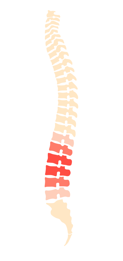 sciatica, sciaitic pain nerve compression spine back pain Osteopath Bodytonic clinic London