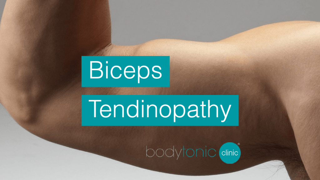 Biceps Tendinopathy bodytonic clinic London