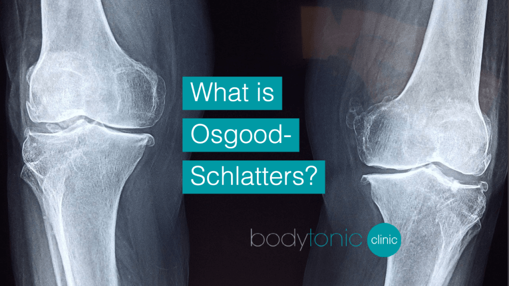 What is Osgood-Schlatters bodytonic clinic SE16 London