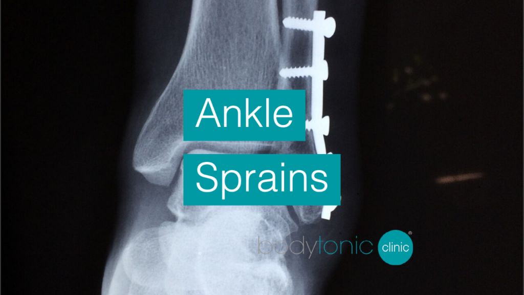 Ankle Sprains bodytonic clinic SE16 London