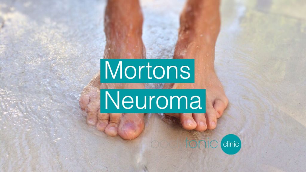 Mortons Neuroma bodytonic clinic SE16