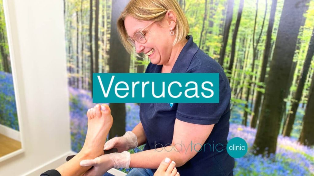 Verrucas and warts treatment at bodytonic clinic SE16 London Canada Water Stratford Canary Wharf E14