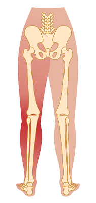 sciatica-sciatic nerve-pain bodytonic clinic london Canada Water SE16 E14 Stratford E15 bodytonic clinic