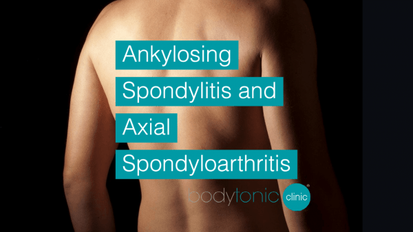 ankylosing spondylitis