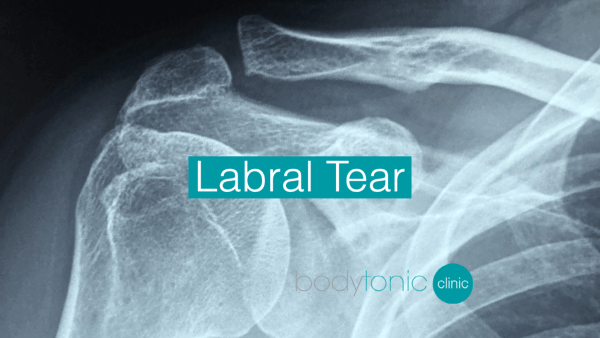 labral tear