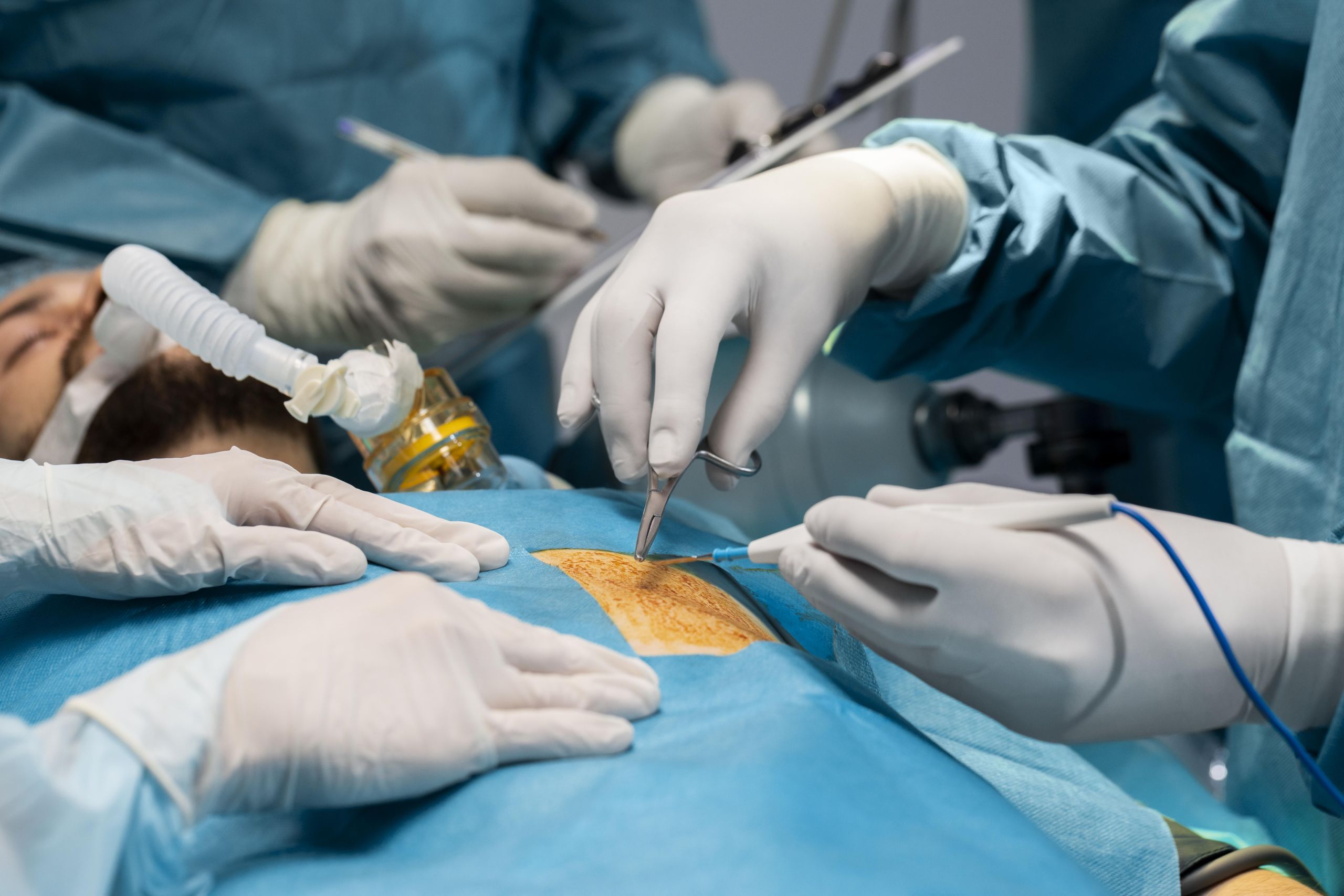 Close-up view of a surgical team performing an operation on a patient’s back, with gloved hands using instruments under sterile conditions.