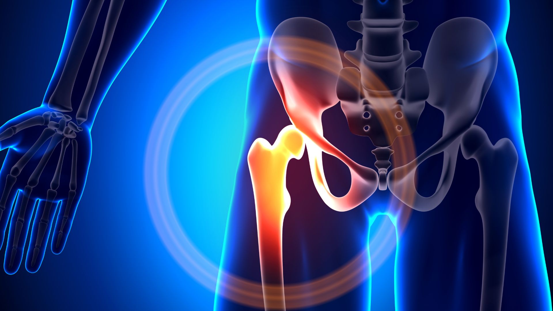 Trochanteric Bursitis vs Gluteal Tendinopathy