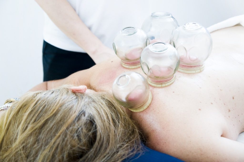 cupping therapy