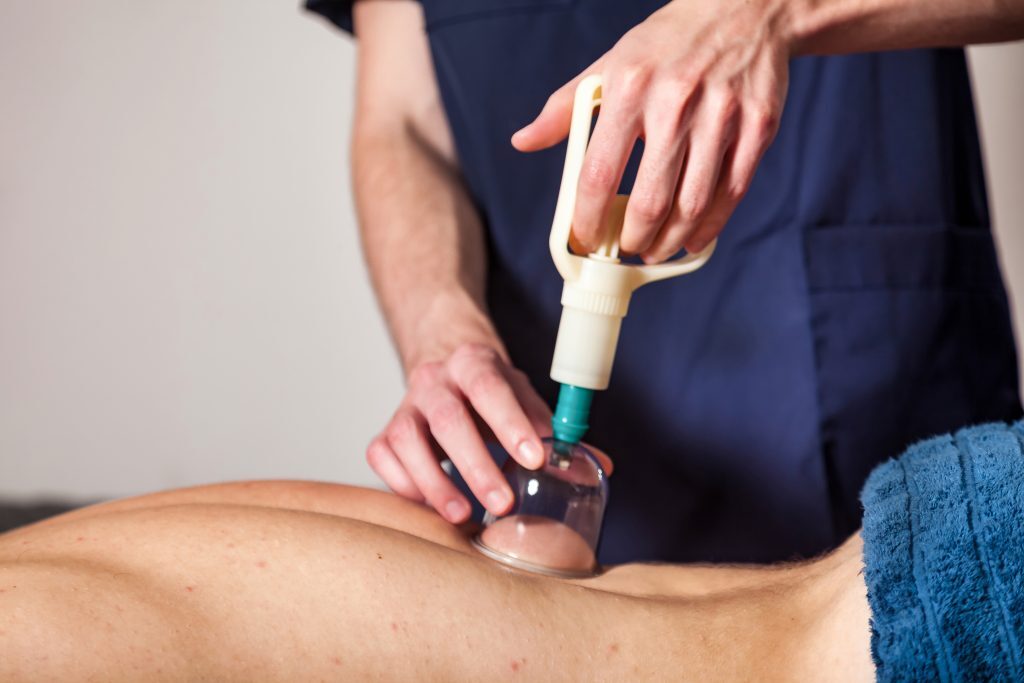 Doctor doing vacuum cups for patient; therapy. Medical cupping therapy on human body; close-up multiple cups in hands. Wellness; health injury rehabilitation concept. Alternative medicine. Copy space