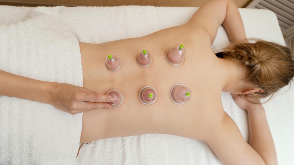 Woman lying face down with multiple suction cups placed on her back for cupping therapy.