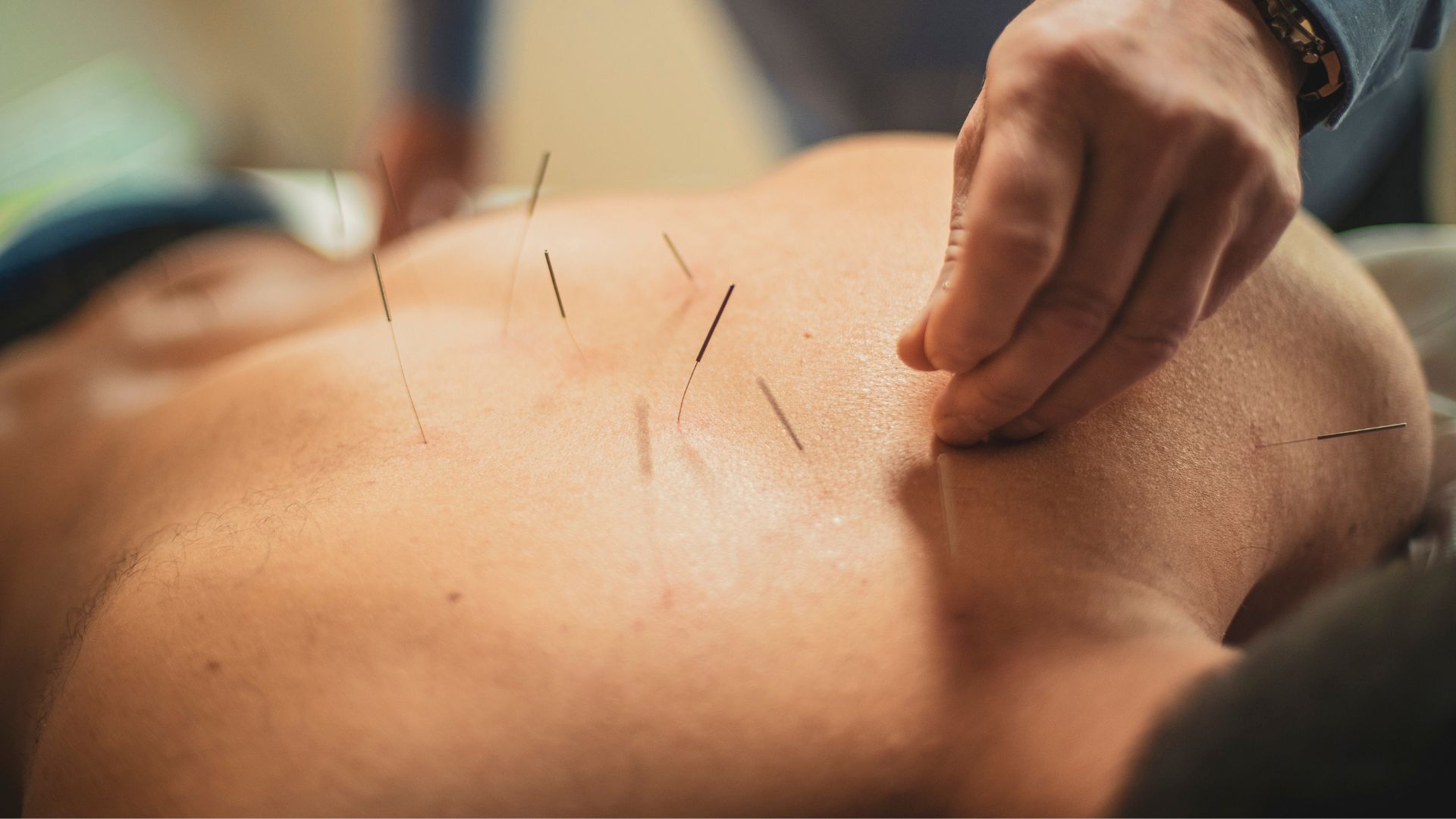 A close-up of a therapist inserting thin acupuncture needles into a patient's bare back during treatment.