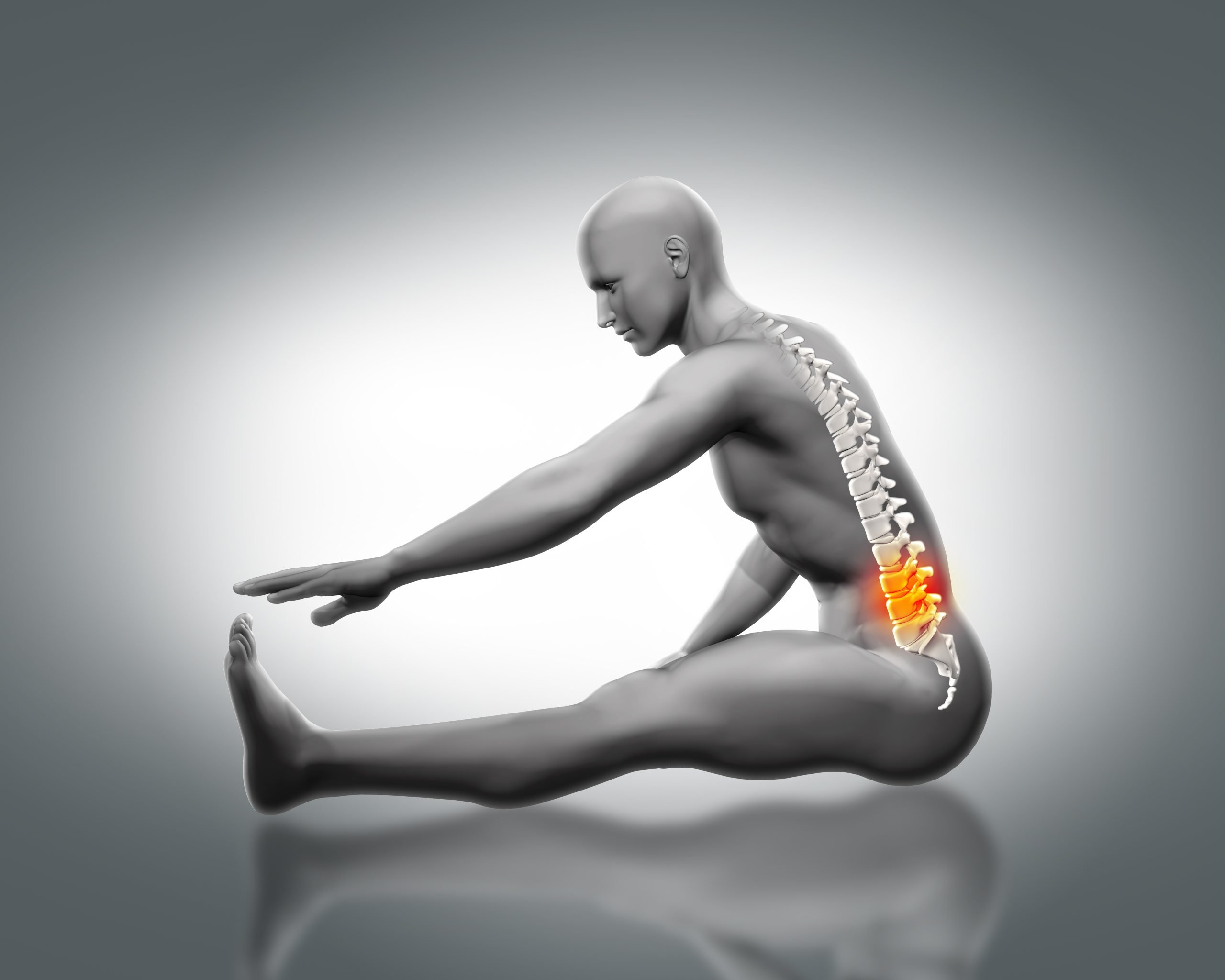 pain lumbar scaled Cervical Radiculopathy