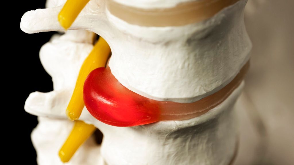 A 3D medical model of a spinal vertebra with a red-highlighted lumbar disc bulge pressing against a nerve.