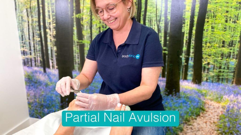 Partial Nail Avulsion in London - Expert podiatrists treating ingrown toenails with safe and effective surgery.
