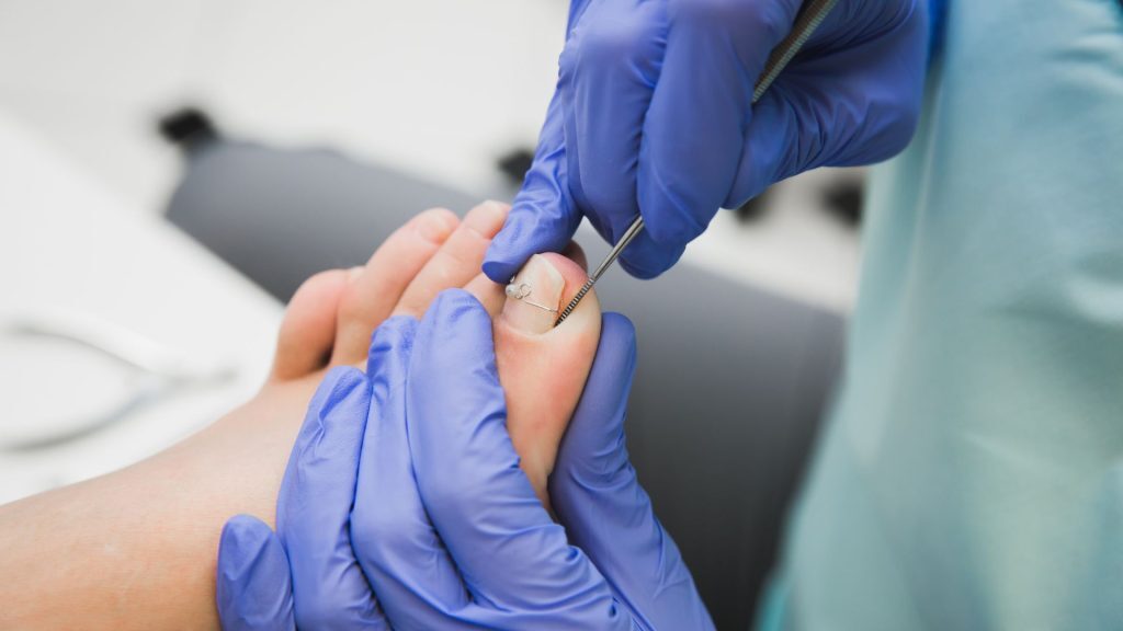 Close-up of a healthcare professional wearing blue gloves performing an ingrown toenail correction using a small wire and tool