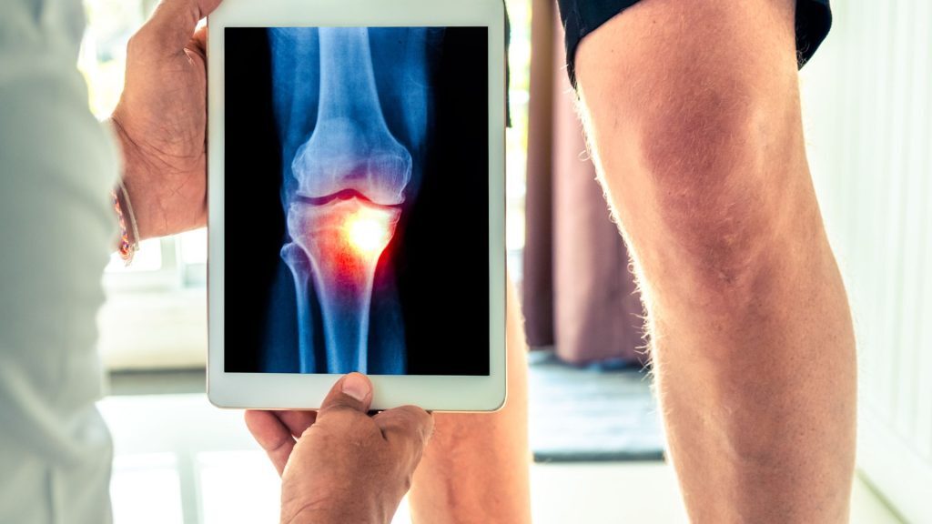 Doctor holding a tablet showing a knee X-ray with joint inflammation.