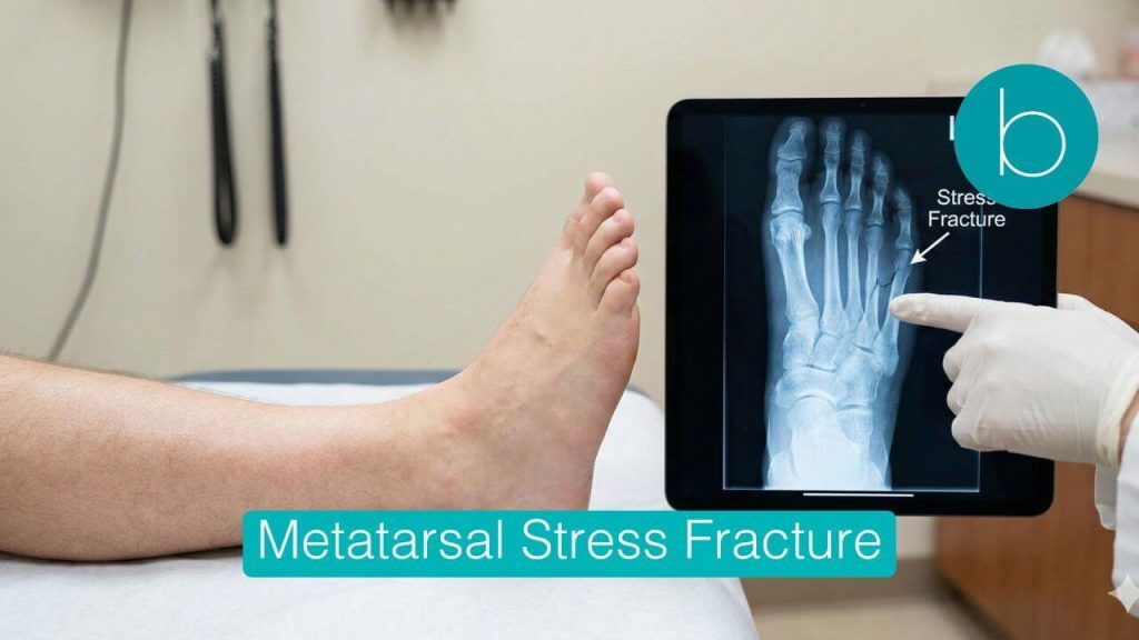 A doctor points to a digital X-ray on a tablet showing a labeled stress fracture in a patient's foot metatarsal bone, with the patient's foot in the foreground.