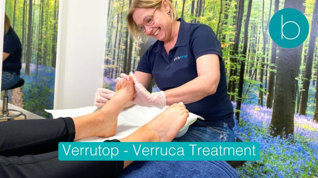 HCPC registered podiatrist applying Verrutop painless verruca treatment at Bodytonic Clinic London.
