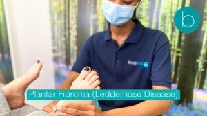 Plantar Fibroma (Ledderhose Disease)